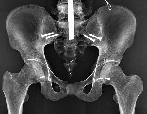 The ability of plain radiography to accurately describe the bone surface at the head-neck junction of the femur: a study using human bone models.