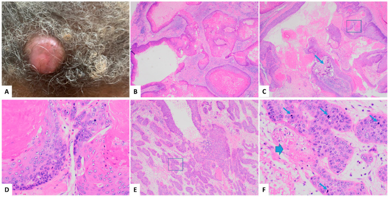 A Rare Case of a Malignant Proliferating Trichilemmal Tumor: A Molecular Study Harboring Potential Therapeutic Significance and a Review of Literature.