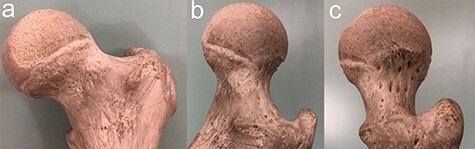 The ability of plain radiography to accurately describe the bone surface at the head-neck junction of the femur: a study using human bone models.