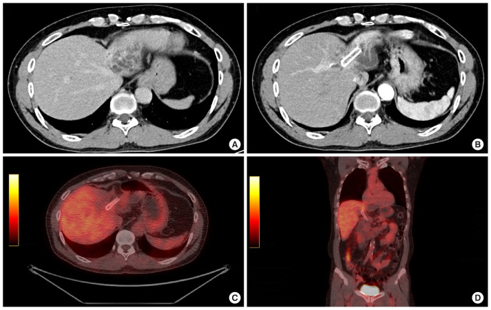 Long-term tumor suppression in cholangiocarcinoma using cytokine-induced killer cell therapy and high-dose vitamin C: a case report.