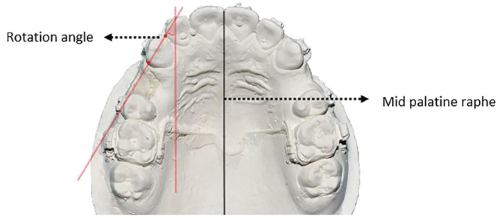 Timing of Therapeutic Extractions Can Affect En Masse Anterior Retraction: A Split Mouth Randomized Clinical Trial.