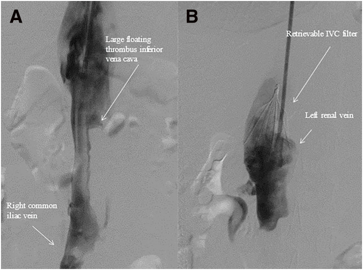 Preceding Antiphospholipid Syndrome before the Onset of Systemic Lupus Erythematosus Presenting with Iliocaval Deep Vein Thrombosis: A Case Report and Literature Review.
