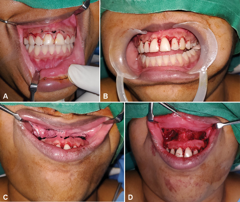 Correction of Gummy Smile: An Essential Procedure in Facial Aesthetics.