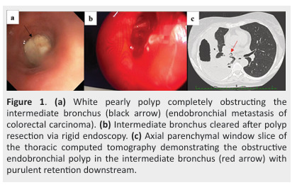 Diagnostic and therapeutic approach to endobronchial metastases from extra-thoracic neoplasms: A report of three cases and brief review of literature.