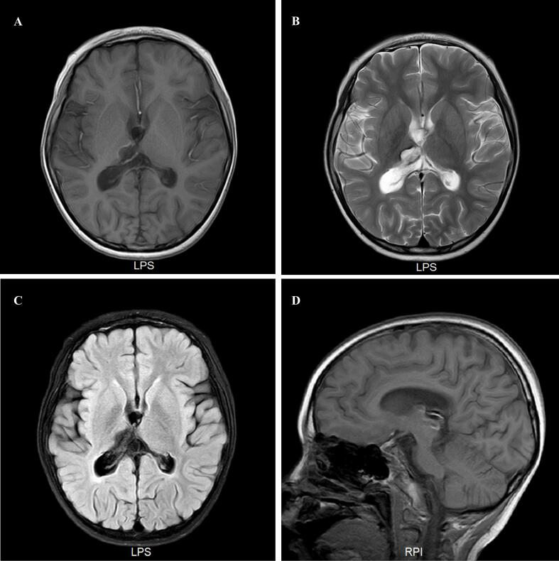 Efficacy of propofol and midazolam combination in managing refractory epileptic encephalopathy with spike-wave activation in sleep