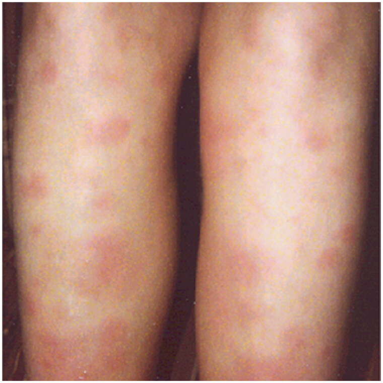 Navigating sarcoidosis: Recognizing, managing, and supporting patients in primary care.