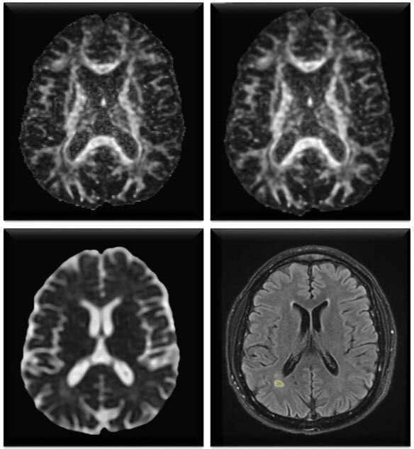Assessment of axonal injury in multiple sclerosis: combined analysis of serum light-chain neurofilaments and diffusion tensor imaging.