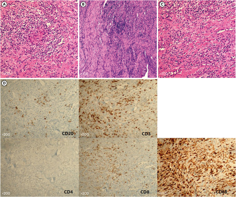 Myelopathy Due to Hypertrophic Pachymeningitis Associated With ANCA Vasculitis: A 10-Year Follow-up Case Report.