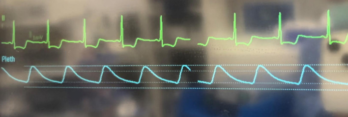 Intraoperative ST Segment Depression During General Anesthesia in a Child: Early Detection of Hypertrophic Cardiomyopathy.