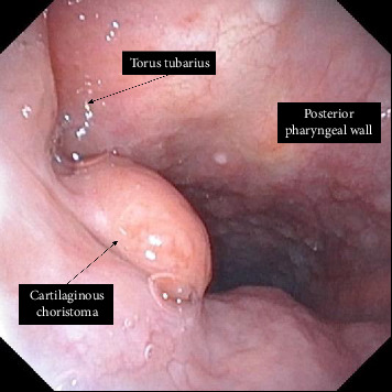 Cartilaginous Choristoma of the Oral Cavity: A Rare Presentation in the Nasopharynx.