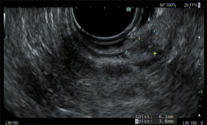 A 13-year-old with dual pancreatic rests.