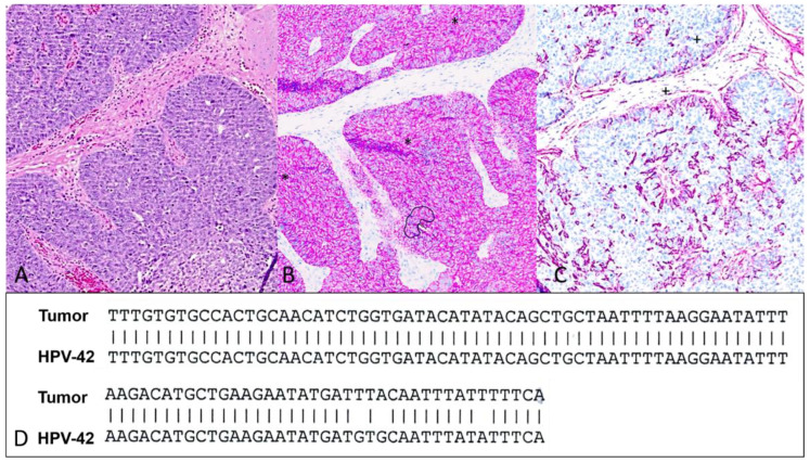 Digital Papillary Adenocarcinoma Is HPV-42-Associated and BRAFV600E Negative: Perspectives for Diagnostic Practice.