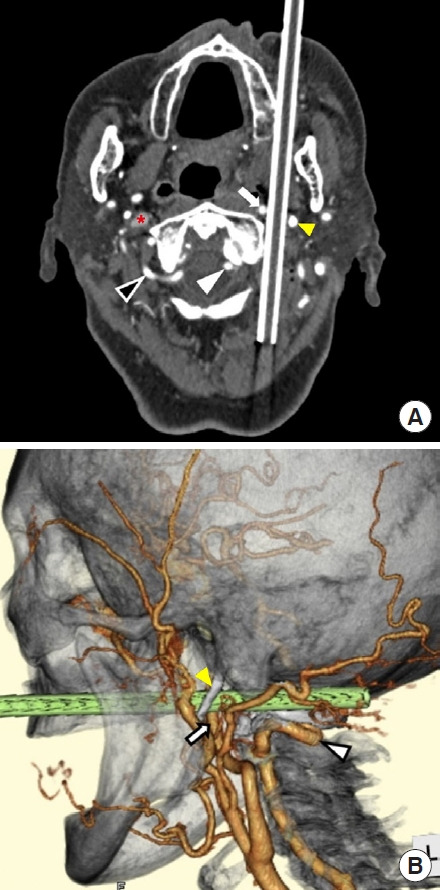 Removal of a gardening pole penetrating the vicinity of the internal carotid and vertebral arteries.