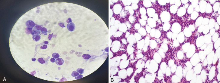 Daratumumab and Eltrombopag for Pure Red Cell Aplasia Following ABO-Incompatible Allogeneic Hematopoietic Stem Cell Transplant for Acute Lymphoblastic Leukemia