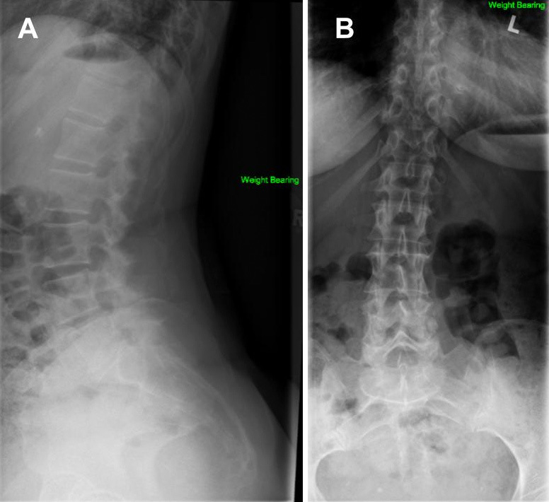 Severe Spinal Stenosis Secondary to a CREST Syndrome Related Calcific Deposit: A Case Report.