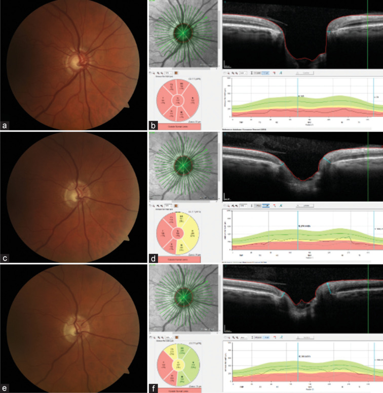 Reversal of cup-to-disc ratio following trabeculectomy using optical coherence tomography imaging: A case series.