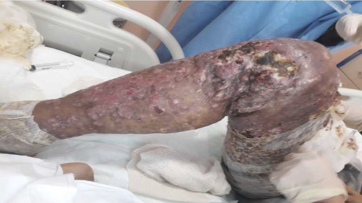 A Case of Rapidly Progressing Tumoral-Stage Mycosis Fungoides
