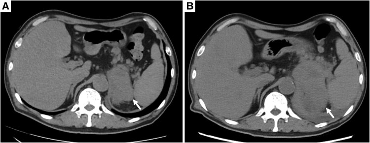 Primary Unilateral Adrenal Anaplastic Large Cell Lymphoma: Remission by Chemotherapy.