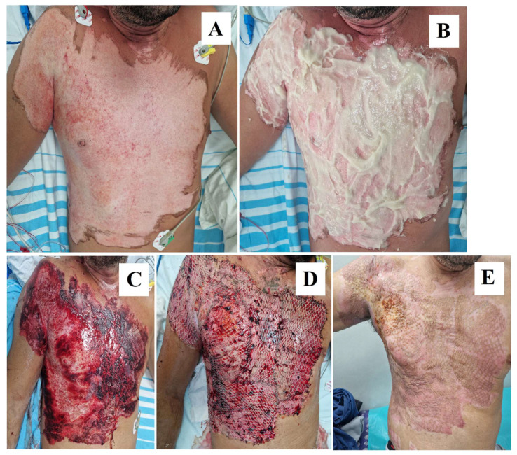 Bromelain in Burn Care: Advancements in Enzymatic Debridement and Patient Outcomes.