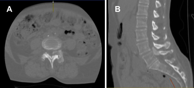 Severe Spinal Stenosis Secondary to a CREST Syndrome Related Calcific Deposit: A Case Report.