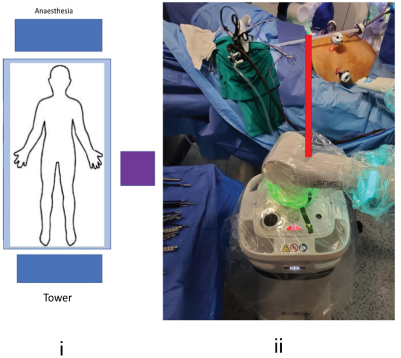Robot-assisted radical prostatectomy with the Versius surgical platform: An objective criticism and a guide for an optimal surgical setup.