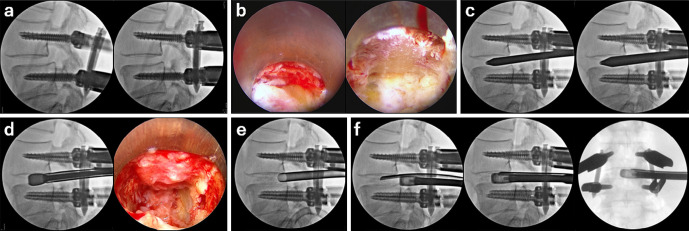 Comparative Study between Full-Endoscopic Transforaminal Approach Lumbar Interbody Fusion (TF-LIF) Using PETLIF System and Minimally Invasive TLIF for Degenerative Lumbar Spine Disorders.