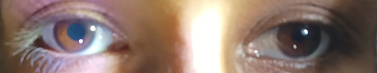 Adie's pupil and systemic manifestations: a rare unilateral presentation.