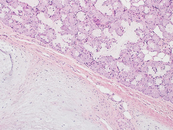 Cartilaginous Choristoma of the Oral Cavity: A Rare Presentation in the Nasopharynx.