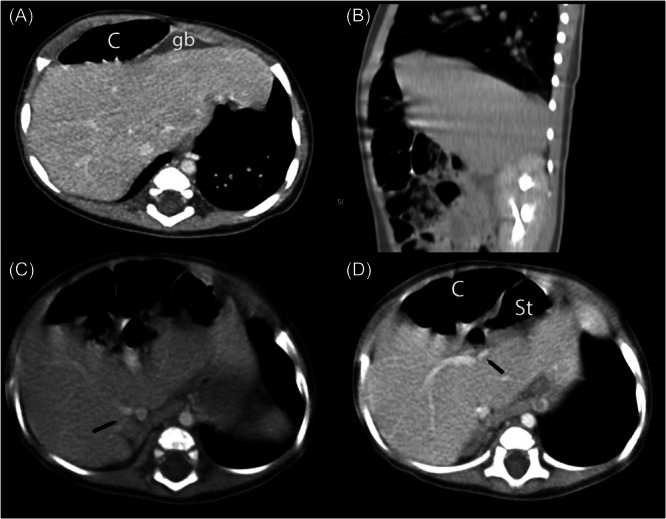 Left-sided gallbladder and Chilaiditi syndrome in an infant.