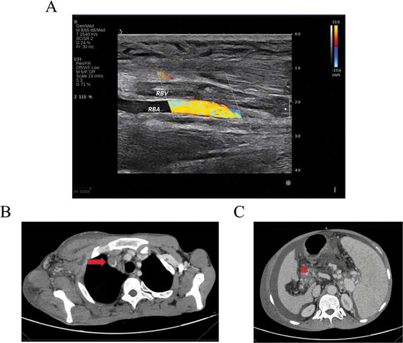 Digenic Inheritance of PROC and SERPINC1 Mutations Contributes to Multiple Sites Venous Thrombosis.