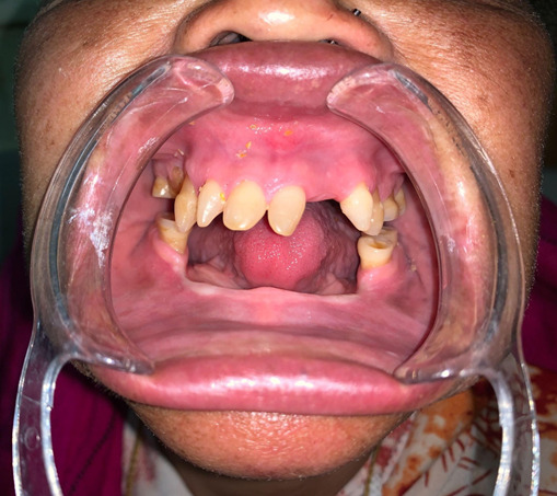 Nasal Myiasis in a Female with Christ-Siemens-Touraine Syndrome: A Case Report.