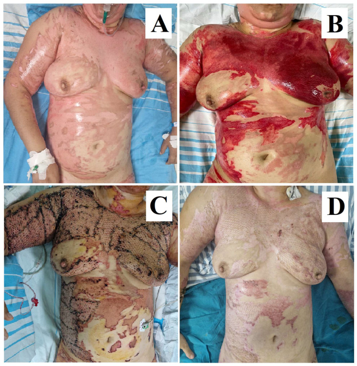 Bromelain in Burn Care: Advancements in Enzymatic Debridement and Patient Outcomes.
