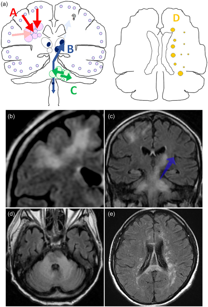 Brain biopsy and pathological diagnosis for drug-associated progressive multifocal leukoencephalopathy (PML) with inflammatory reactions.