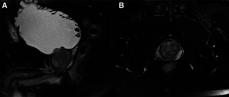 AMPK down-regulating Beclin-1 in prostate cancer patients with bone metastasis: An observational study.