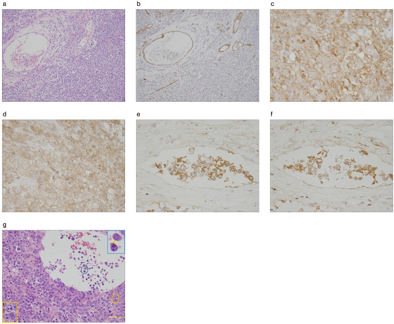 Cell-to-cell adhesion via CD54 (intercellular adhesion molecule-1)-associated cell proliferation in diffuse large B-cell lymphoma cases.