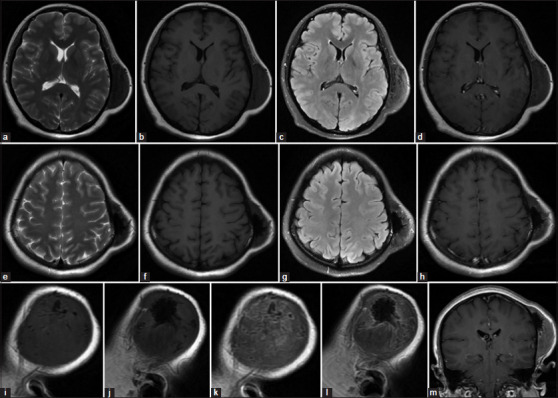 Desmoplastic (collagenous) fibroma of the parietal bone: Case report and review of the literature.