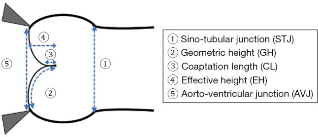 Aortopathy in repaired tetralogy of Fallot and David procedure.