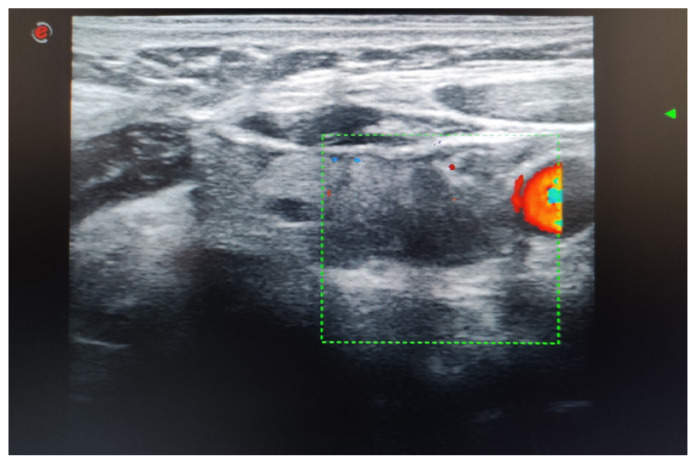 Vitamin D deficiency and surgical cellulose mimicking parathyroid adenoma after initial parathyroidectomy.