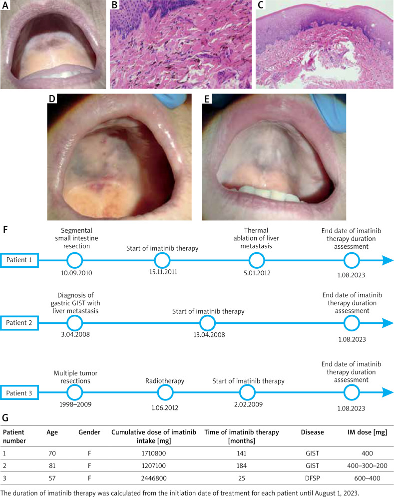 Imatinib-induced hard palate mucosal discoloration in patients with gastrointestinal stromal tumour (GIST) and dermatofibrosarcoma protuberans (DFSP): a case series of three patients and literature review.