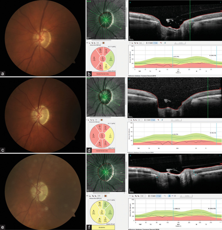 Reversal of cup-to-disc ratio following trabeculectomy using optical coherence tomography imaging: A case series.