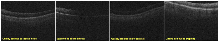 Inter-rater reliability in labeling quality and pathological features of retinal OCT scans: A customized annotation software approach.