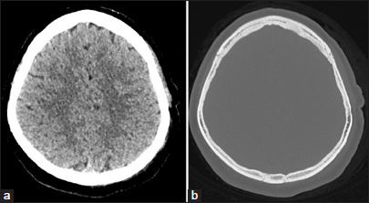 Desmoplastic (collagenous) fibroma of the parietal bone: Case report and review of the literature.