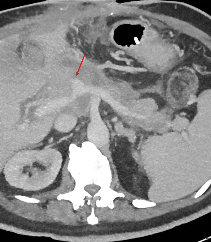 Endovascular Management of a Portal Vein Pseudoaneurysm following Pancreatoduodenectomy: A Case Report and Review of Literature.
