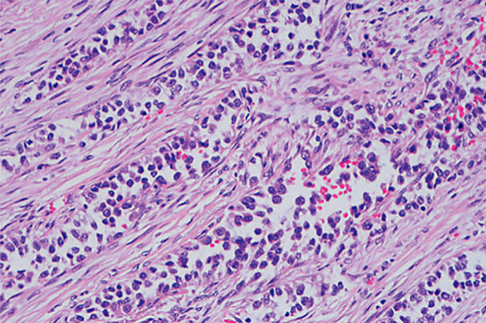 Gastrointestinal Neuroectodermal Tumor/Extraskeletal Ewing Sarcoma of the Ileum with Ulcerative Colitis.