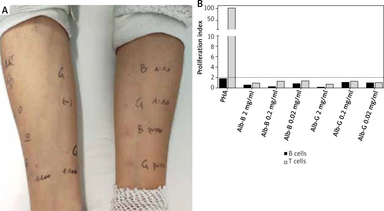 Rapid desensitization for human serum albumin (Grifols<sup>®</sup>) hypersensitivity.