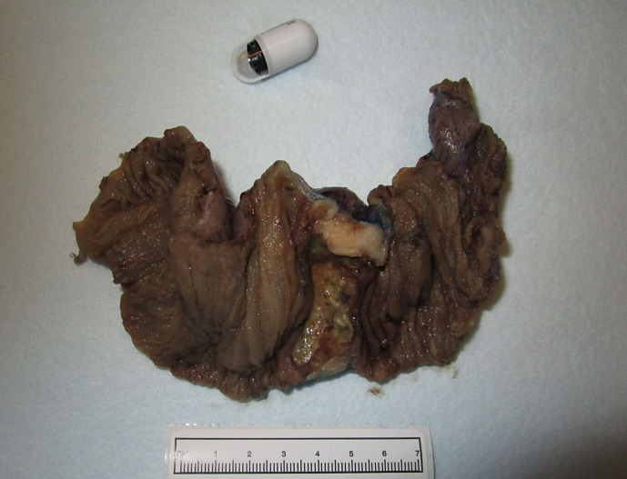 Gastrointestinal Neuroectodermal Tumor/Extraskeletal Ewing Sarcoma of the Ileum with Ulcerative Colitis.