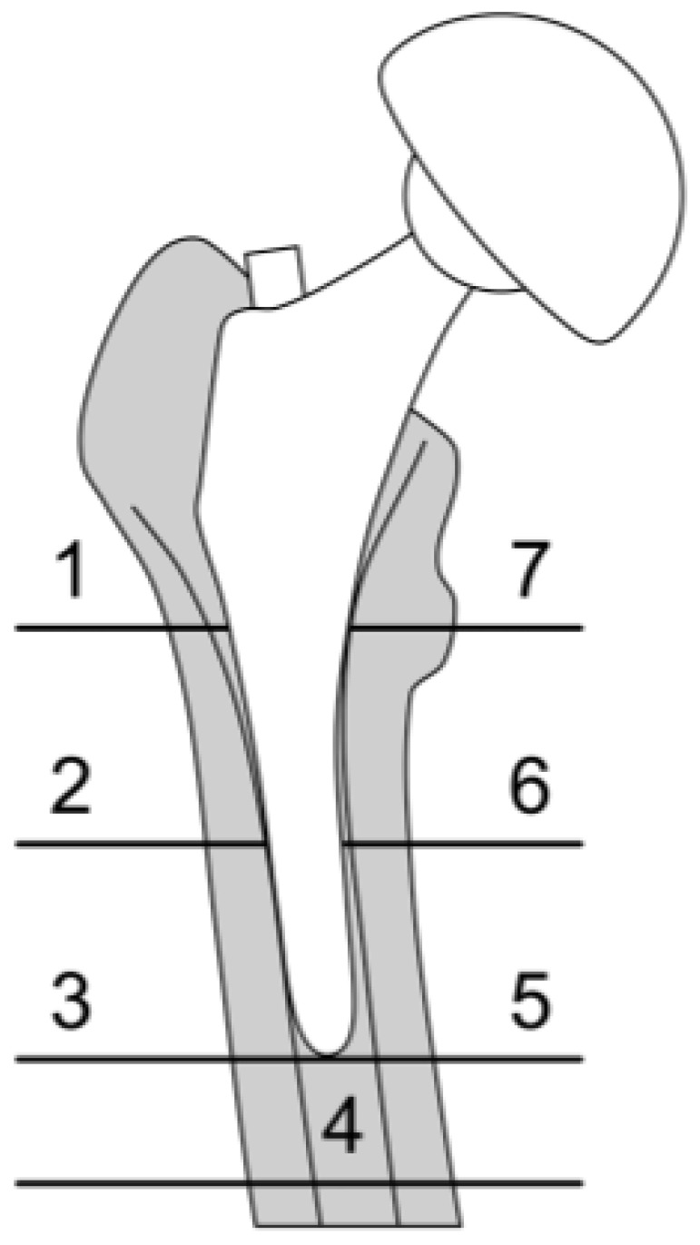Total Hip Arthroplasty in Patients with Hip Osteoporosis: A Narrative Review.