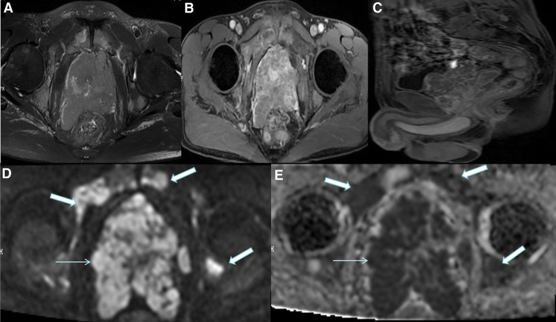 AMPK down-regulating Beclin-1 in prostate cancer patients with bone metastasis: An observational study.