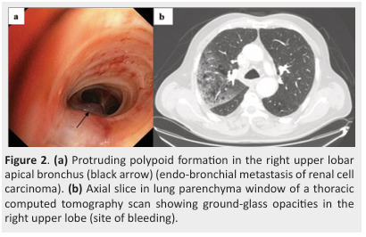 Diagnostic and therapeutic approach to endobronchial metastases from extra-thoracic neoplasms: A report of three cases and brief review of literature.