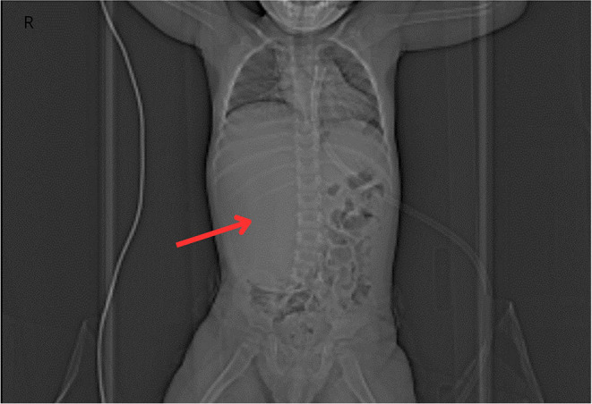 Bilateral Wilms Tumor - Case Report of a Patient with Family History.